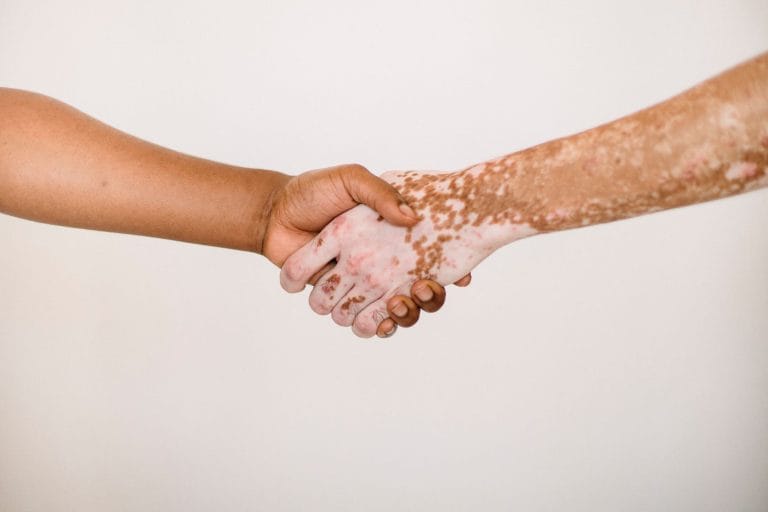 Can Your Grocery List Really Calm a Psoriasis Flare?