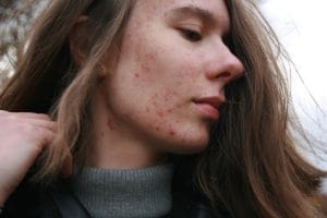 How to Reduce Swelling on Face: Causes & Remedies