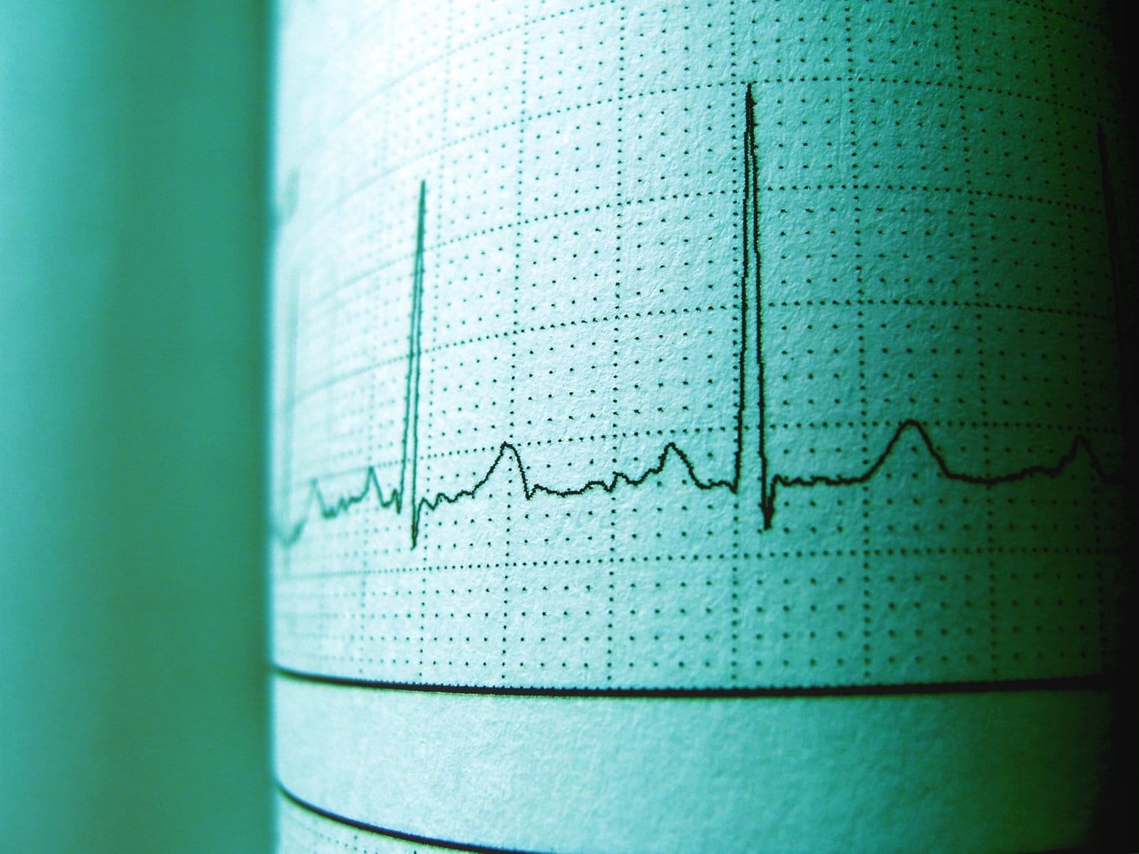 Close-up of an ECG printout on green grid paper showing a heart rhythm trace